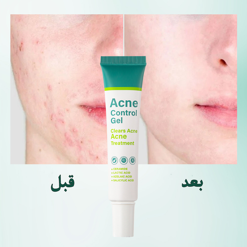 الجال الموضعي  لعلاج حب الشباب Acne Control Gel